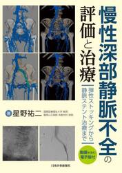 慢性深部静脈不全の評価と治療　弾性ストッキングから静脈ステント治療まで