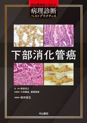 下部消化管癌