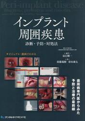 インプラント周囲疾患　診断・予防・対処法
